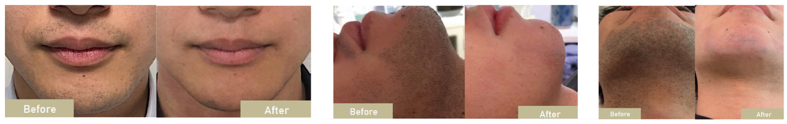 フェイシャル脱毛ビフォーアフター