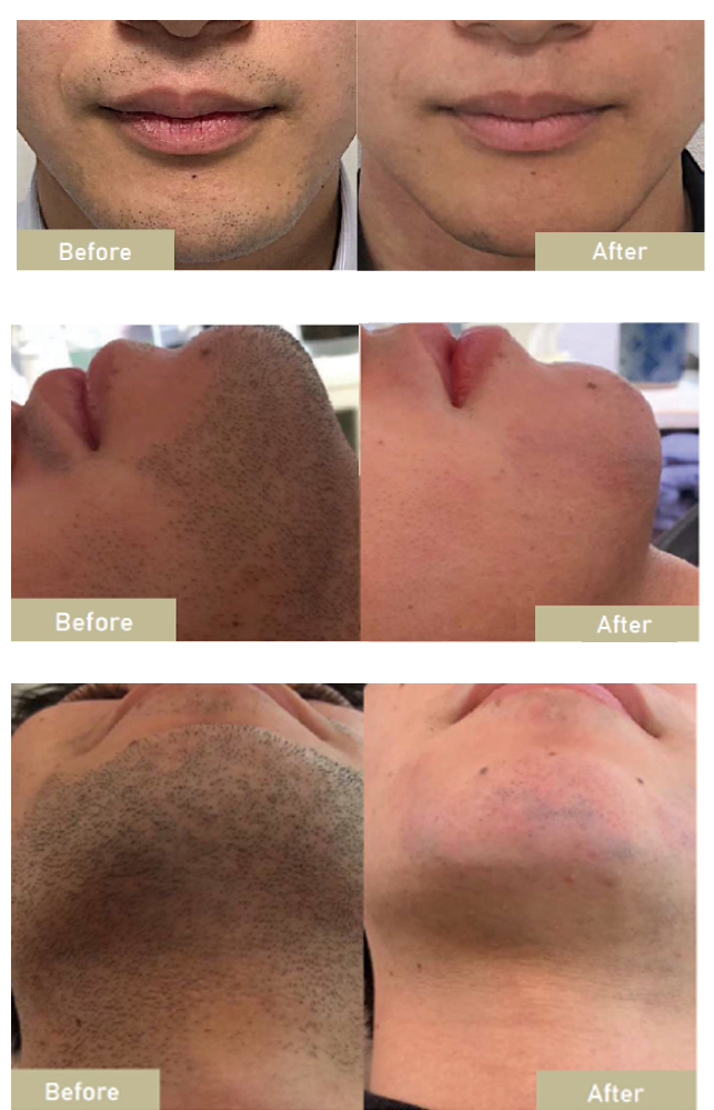 フェイシャル脱毛ビフォーアフター