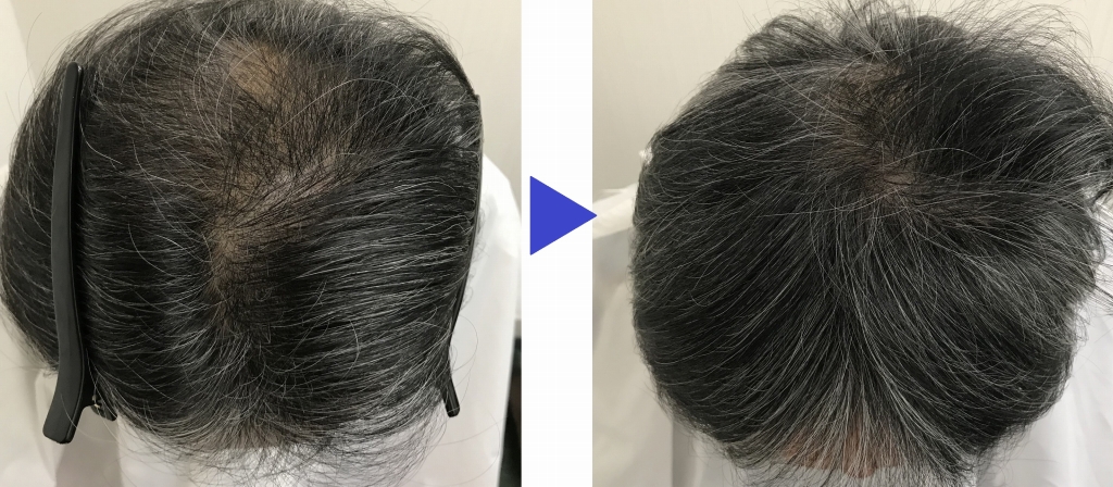 ヴァレッタガーデンメンズ発毛01ビフォー ヴァレッタガーデンメンズ発毛01アフター