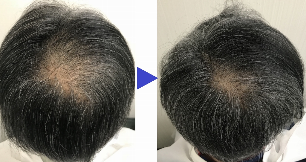 ヴァレッタガーデンメンズ発毛02ビフォー ヴァレッタガーデンメンズ発毛02アフター