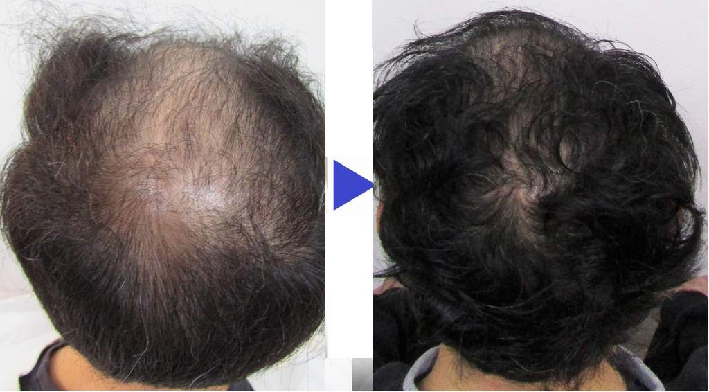 ヴァレッタガーデンメンズ発毛04ビフォー ヴァレッタガーデンメンズ発毛04アフター